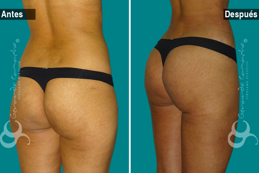 Cambio estético con gluteoplastia en Bogotá